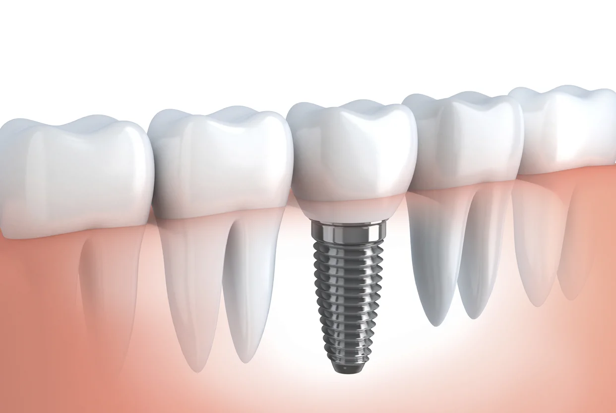 Dental Implants
