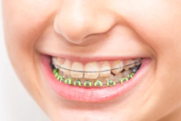 Ceramic Braces or Tooth Coloured Braces