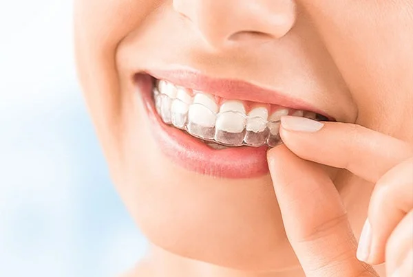 Invisible Aligners