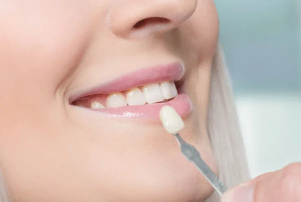 Porcelain Veneer