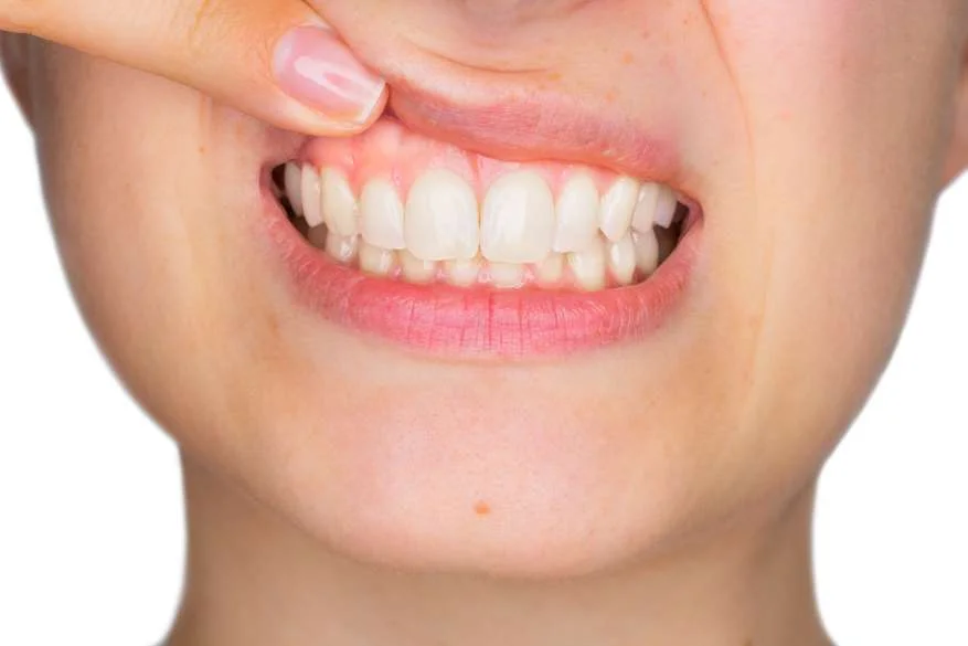 Gum Depigmentation
