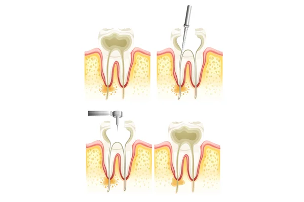 Post and Core Treatment