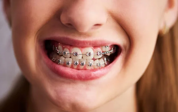 Lingual Braces