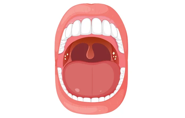 Frenectomy