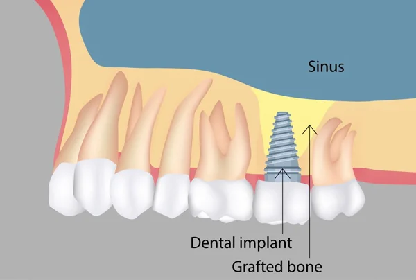 Sinus Lift Procedure